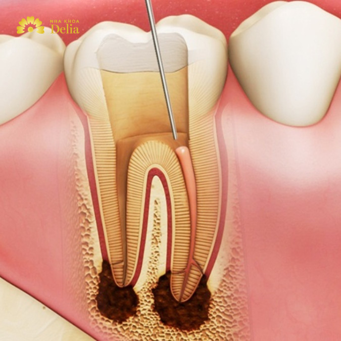 Khi nào cần lấy tủy răng, quy trình lấy tủy răng như thế nào?