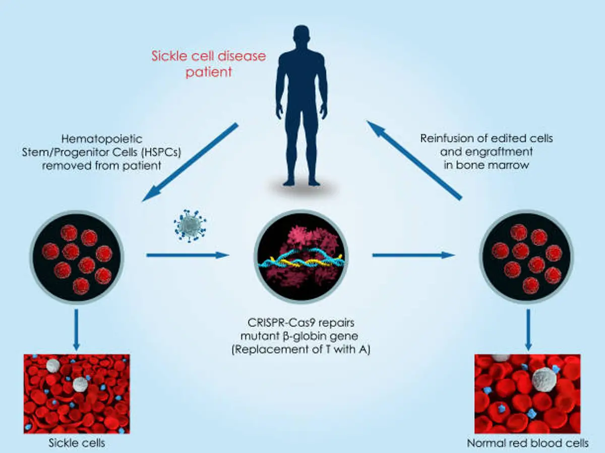 Sickle Cell Disease