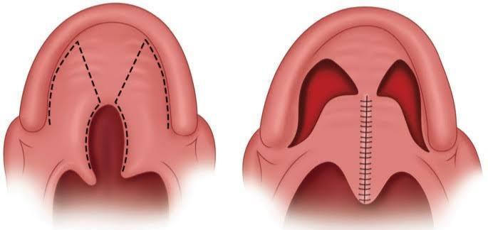Cleft Lip and Palate