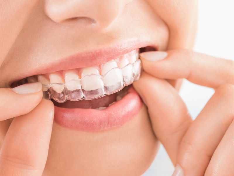 aparelho ortodôntico invisalign tecnologia