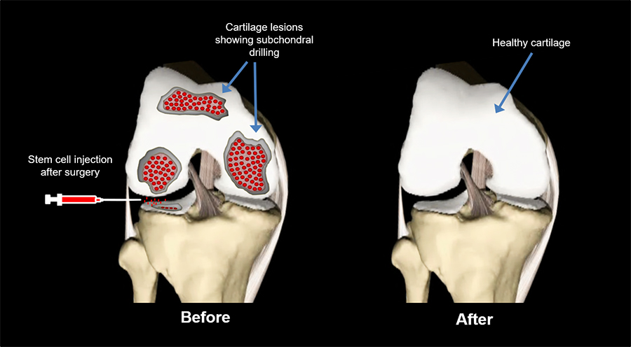 How Do Stem Cells Work to Repair Cartilage?