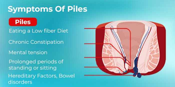 Piles Symptoms