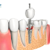 Mất răng sau khi bọc sứ bị viêm tủy có nên trồng Implant hay không?