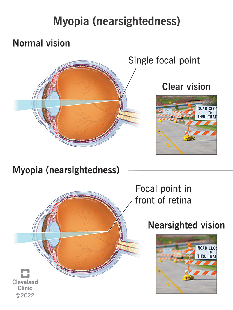 Focus that happens in front of the retina of your eye instead of at the retina results in myopia (nearsightedness). (Source: https://my.clevelandclinic.org/health/diseases/8579-myopia-nearsightedness) 