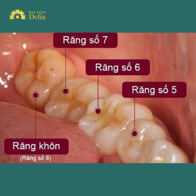 Răng số 7 bị sâu vỡ có nguy hiểm không, khắc phục như thế nào?