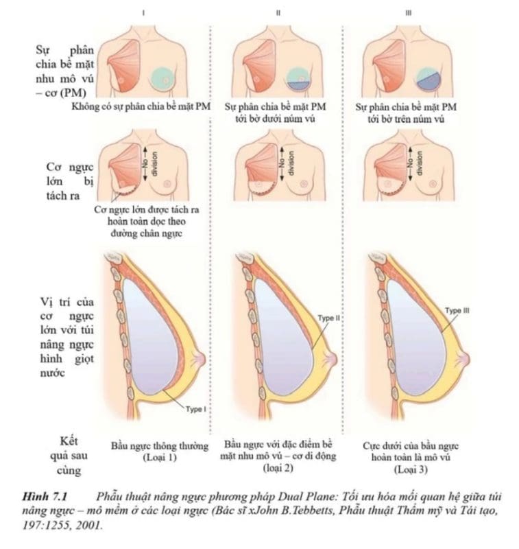 Phương pháp khâu vết mổ thẩm mỹ trong phẫu thuật nâng ngực 