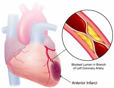 Myocardial Infarction