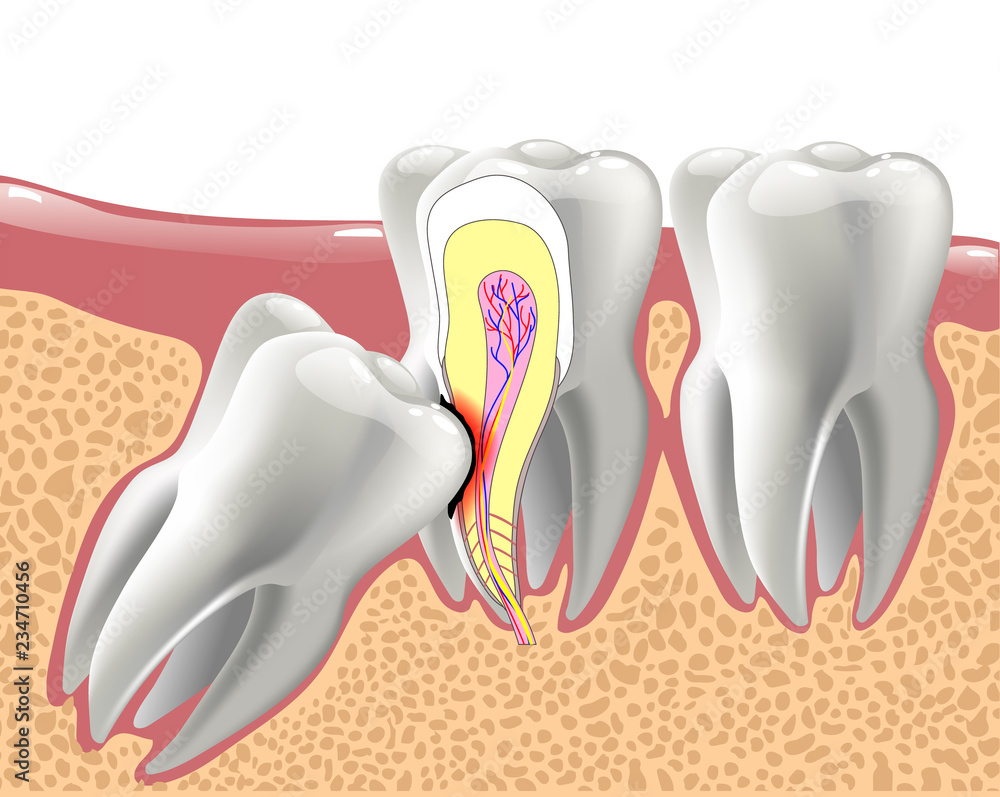 do they dislocate your jaw for wisdom teeth
