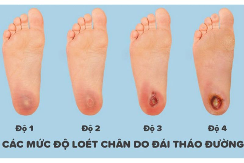 Các giai đoạn biến chứng bàn chân đái tháo đường