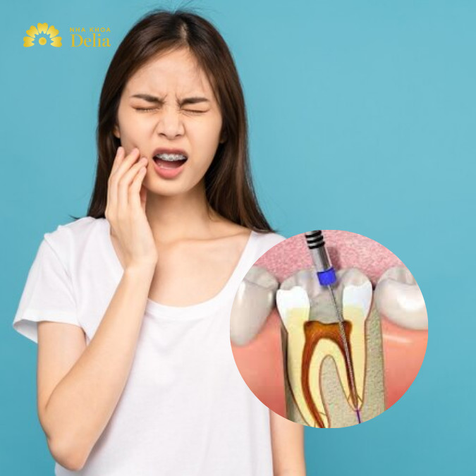 5 nguyên nhân hàng đầu gây đau răng sau khi lấy tủy