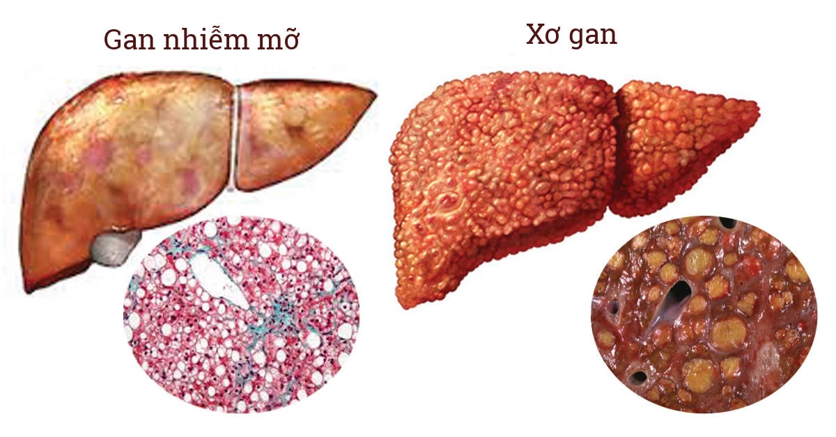 Gan nhiễm mỡ có thể tiến triển xơ gan