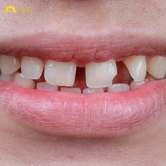 Răng thưa có nguy hiểm không? Nguyên nhân và cách khắc phục hiệu quả
