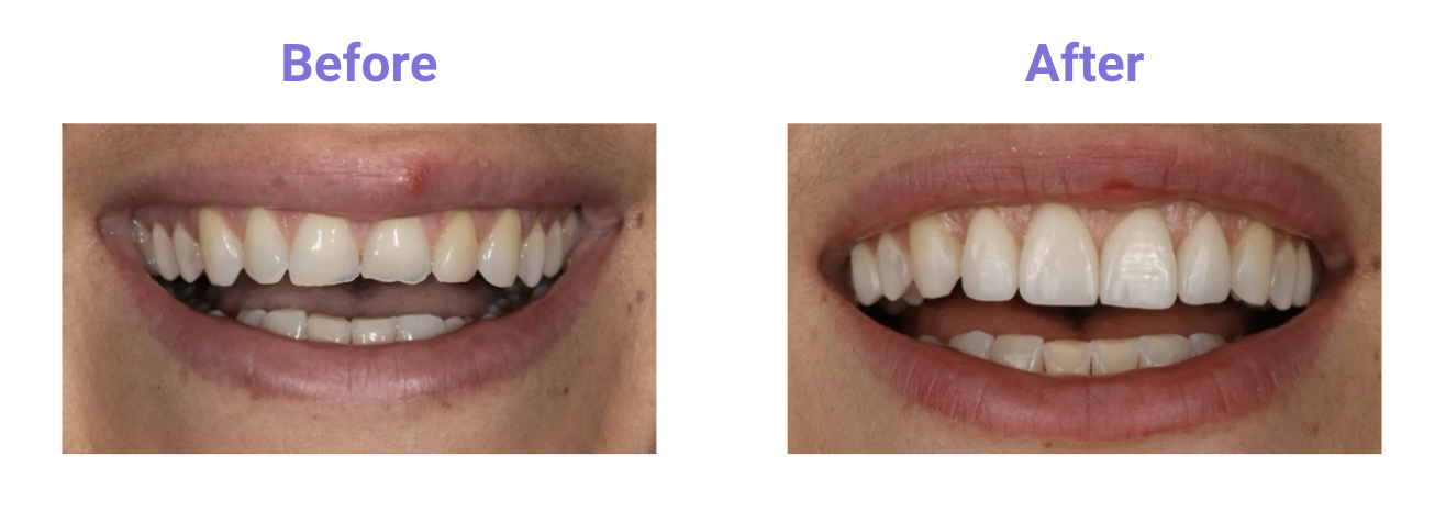 Before and after Veneers