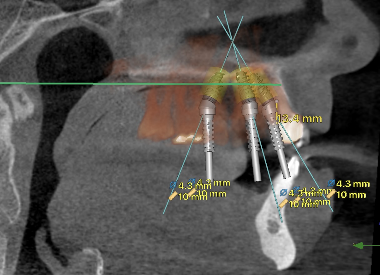 Bone Assessment and Implant Placement