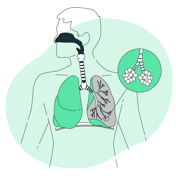 Stem Cell Therapy for Lung Cancer