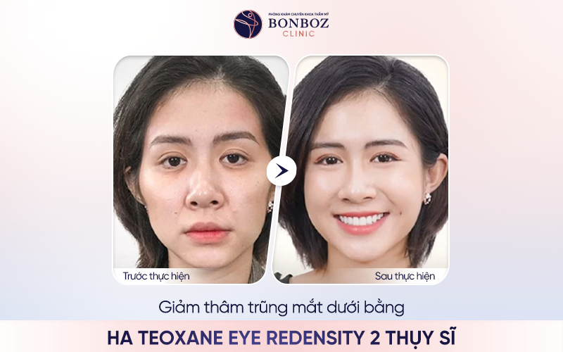 Hiệu quả sau khi giảm thâm trũng mắt dưới bằng HA Teoxane Eye Redensity 2 Thụy Sĩ tại BonBoz