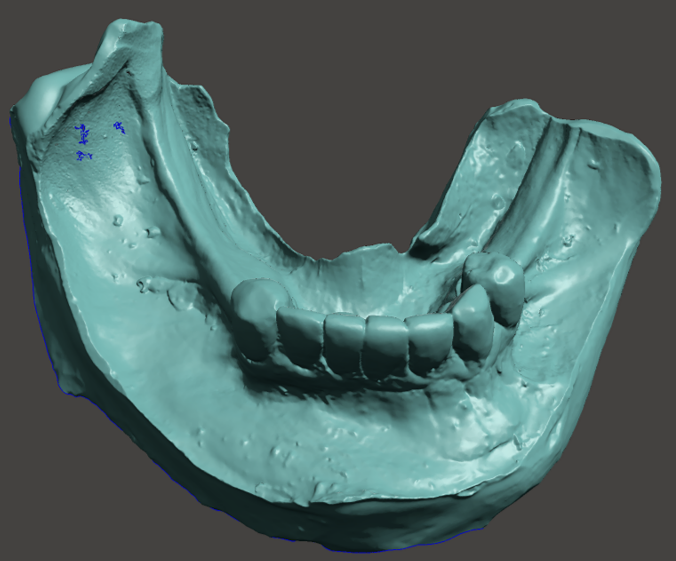 Modelos 3D escaneados y digitalizados de una prótesis dental