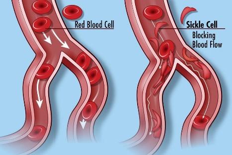 Sickle Cell Disease | Sickle cell disease (SCD) occurs in pe… | Flickr