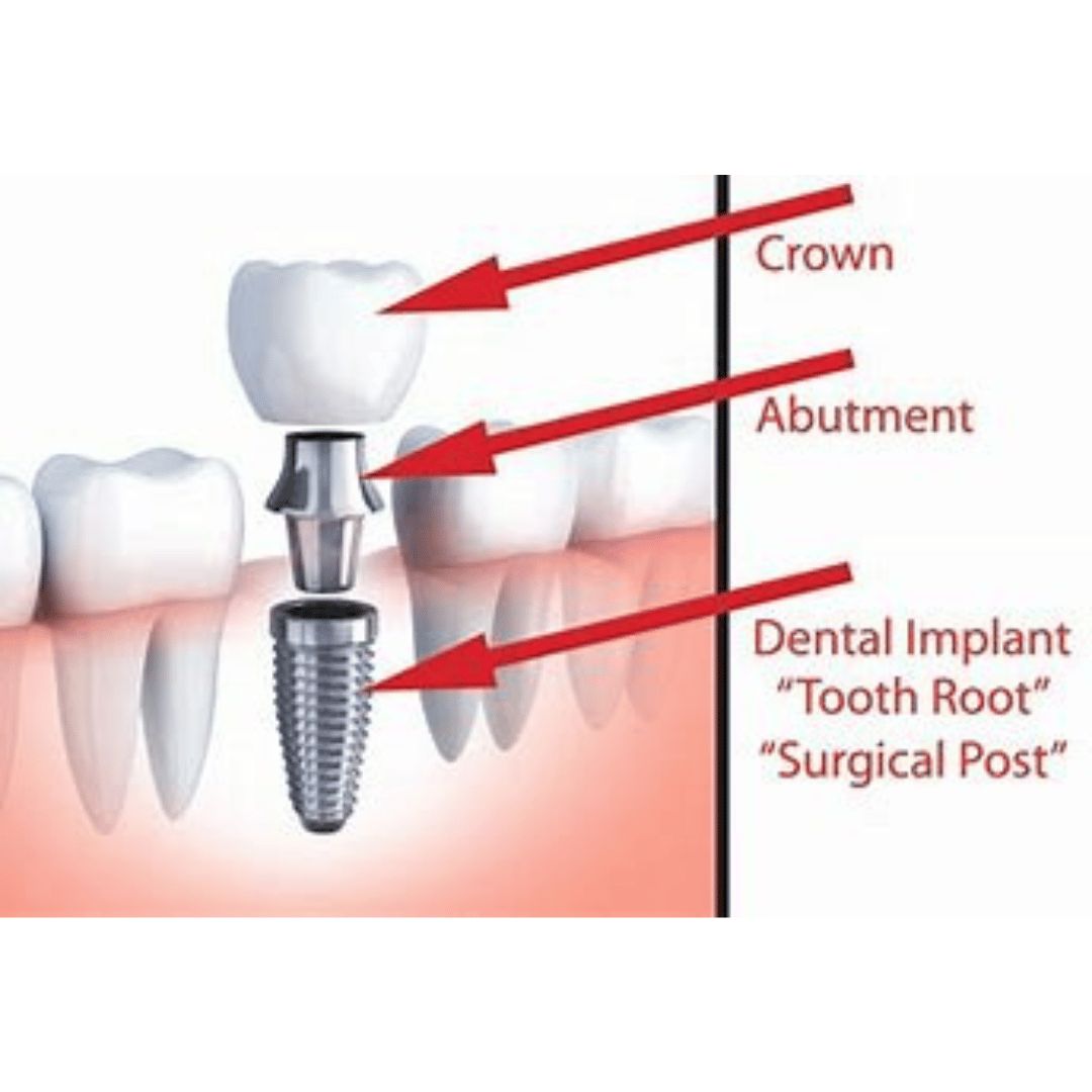 How Do Dental Implants Work