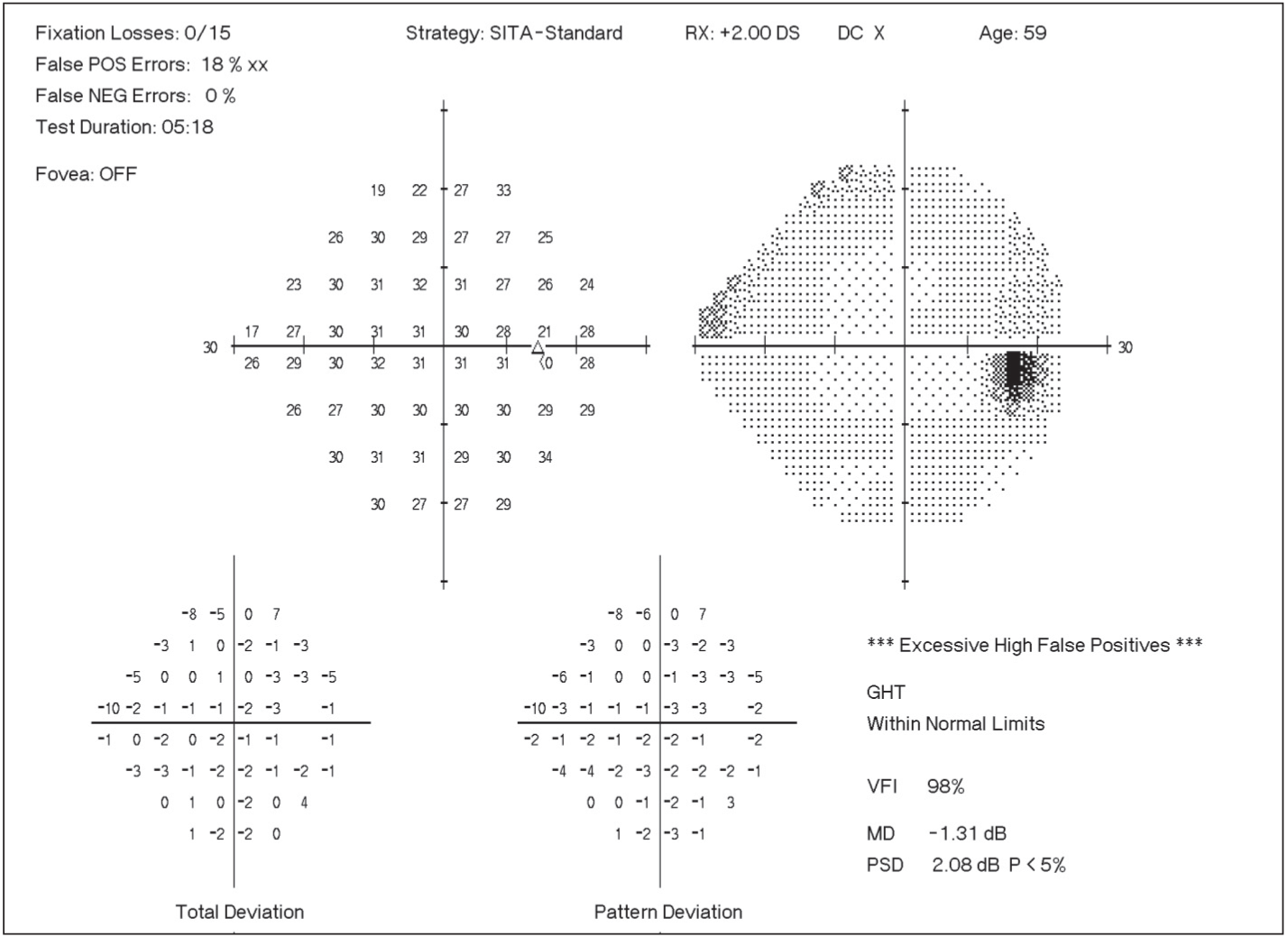 Sharpen Your Visual Field Interpretation Skills | Optometry ...