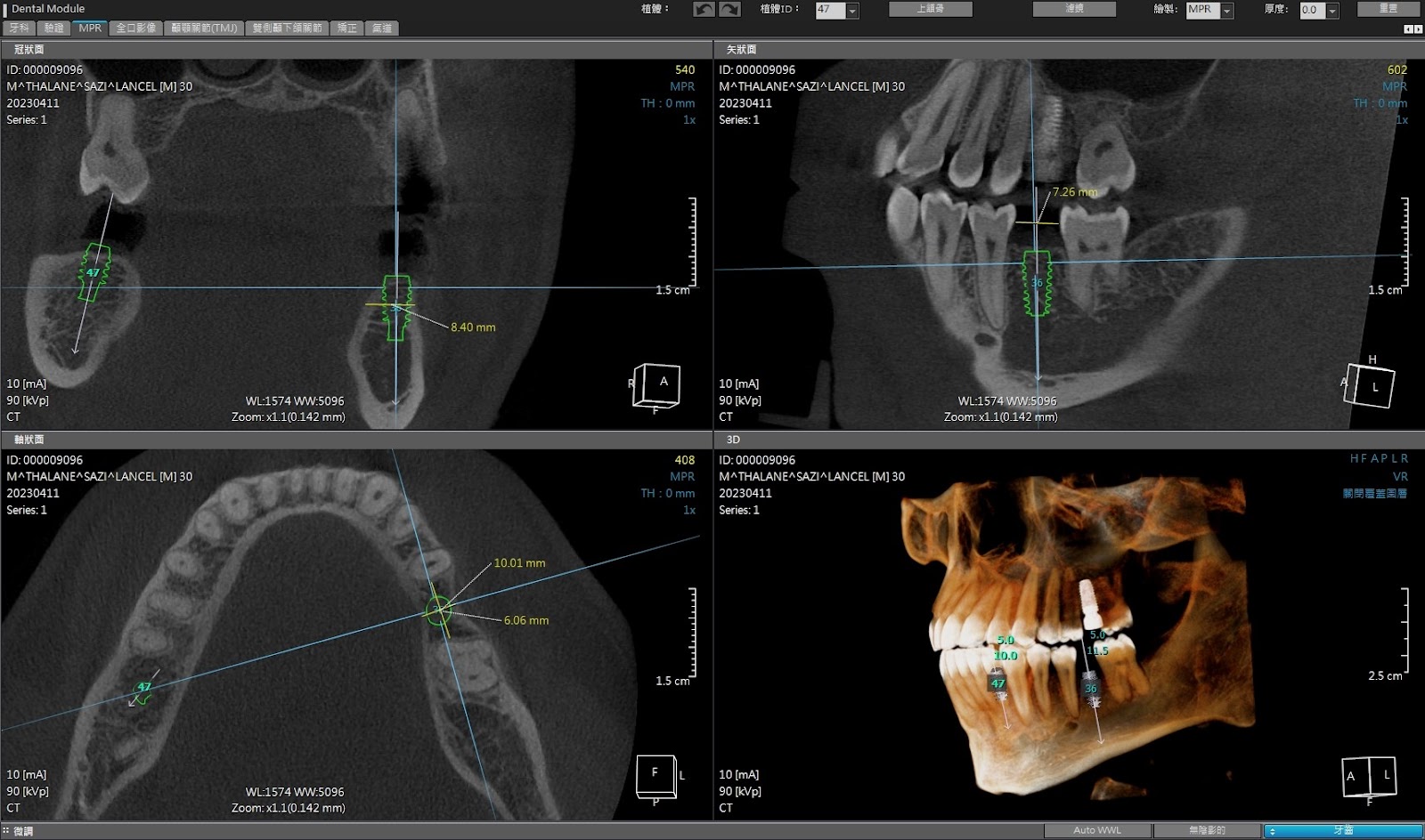 CBCT scan