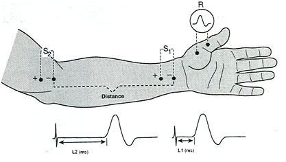 Phương pháp cột điện (Electrocautery)