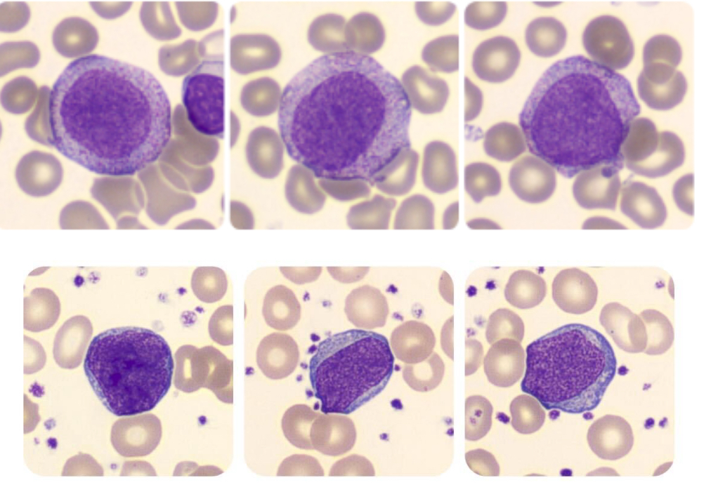 Leucemia Mielomonocítica Crônica