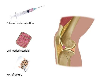 Types of Stem Cells Used for Cartilage Regeneration