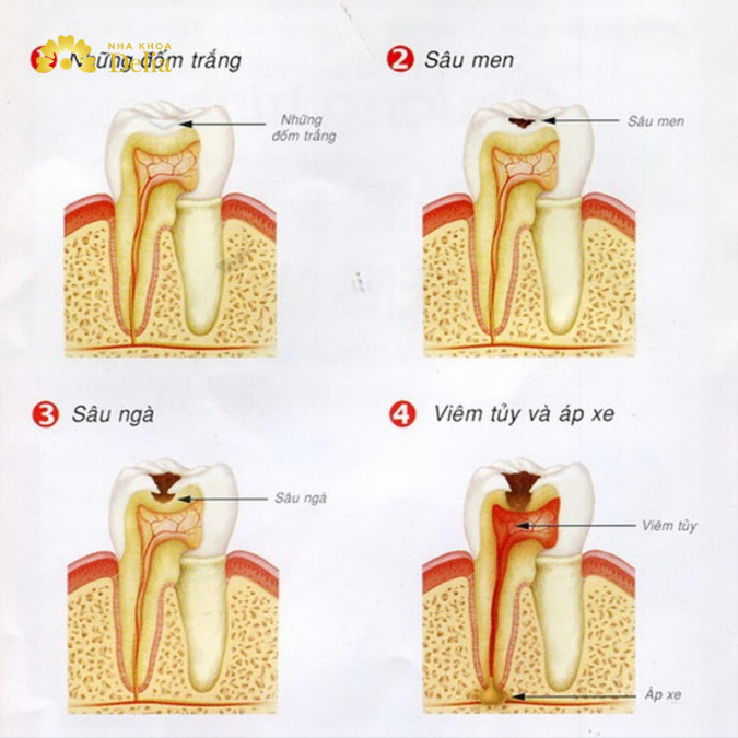 Dấu hiệu và triệu chứng của từng mức độ sâu răng