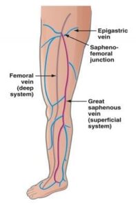 Femoral and saphenous vein in the thigh