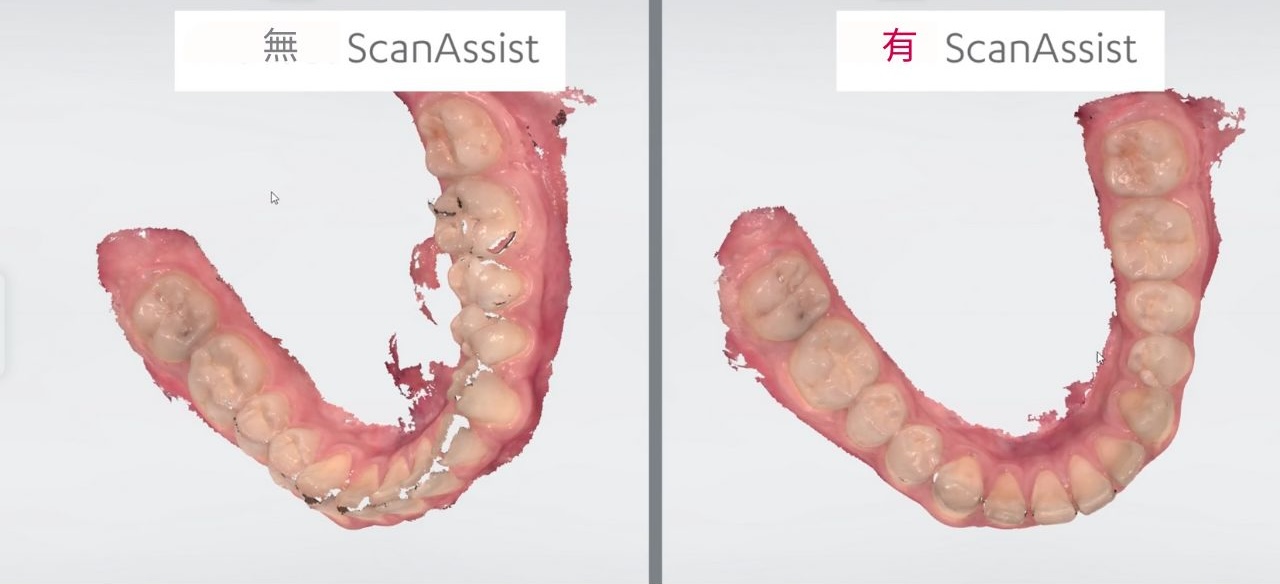 口掃機缺點之一為成像有重疊或變形問題，TRIOS 5 配備了「ScanAssist」功能，讓掃描過程更加順暢。它能夠非常快速地捕捉並連接影像，避免了圖像斷裂的情況，生成的數位模型非常清晰。