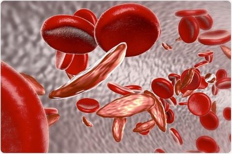 What is Sickle-Cell Disease?