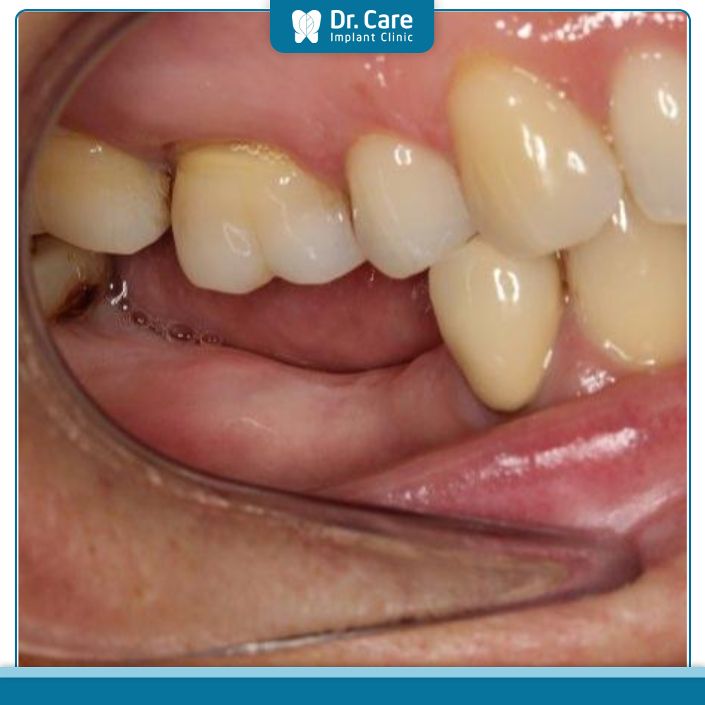 Tác hại nghiêm trọng của việc mất răng hàm, nếu không điều trị kịp thời