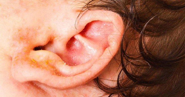 Nguyên nhân gây nhiễm trùng tai