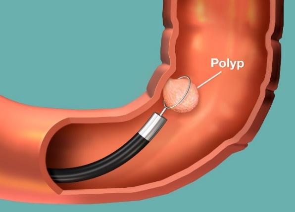 C:\Users\n.matvienko\Desktop\Polyp-Illustration.jpg