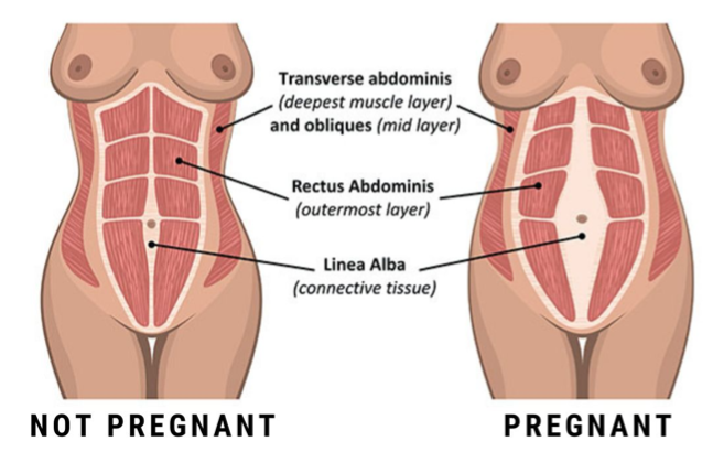 Diastasis recti in pregnancy