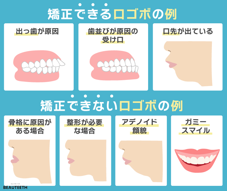 矯正できる口ゴボと矯正できない口ゴボの例