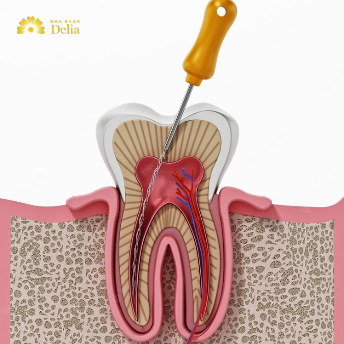 Nên điều trị tủy răng càng sớm càng tốt