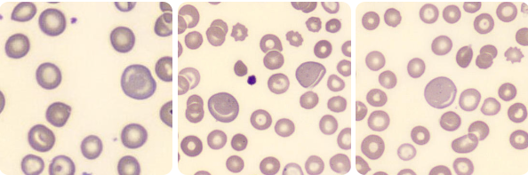 anemia perniciosa