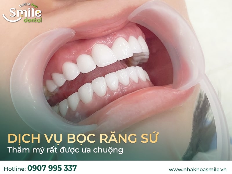 Bọc răng sứ thẩm mỹ là gì?​