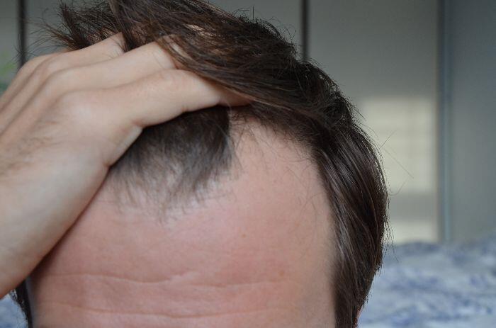 Hair Loss And Pimples on Scalp: Effective Solutions