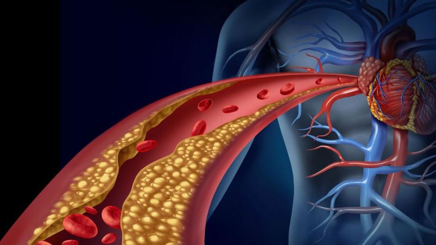 LDL cholesterol làm tích tụ mảng bám trong động mạch tim, có thể gây ra cơn đau tim