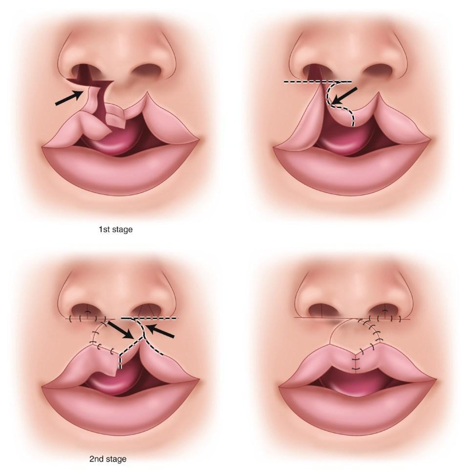 Cleft Lip and Palate