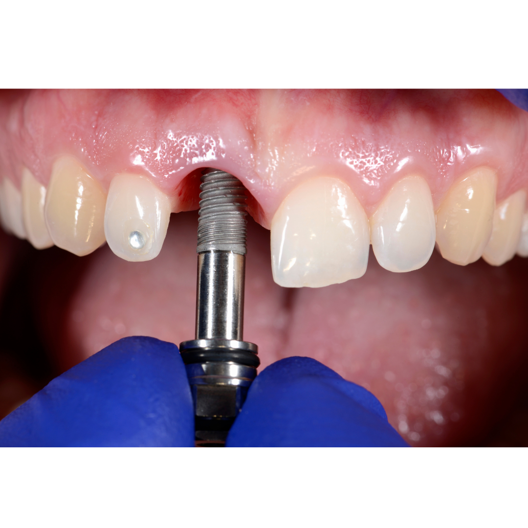 Do dental implants hurt