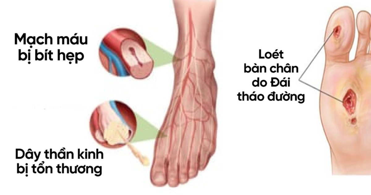 biến chứng bàn chân tiểu đường