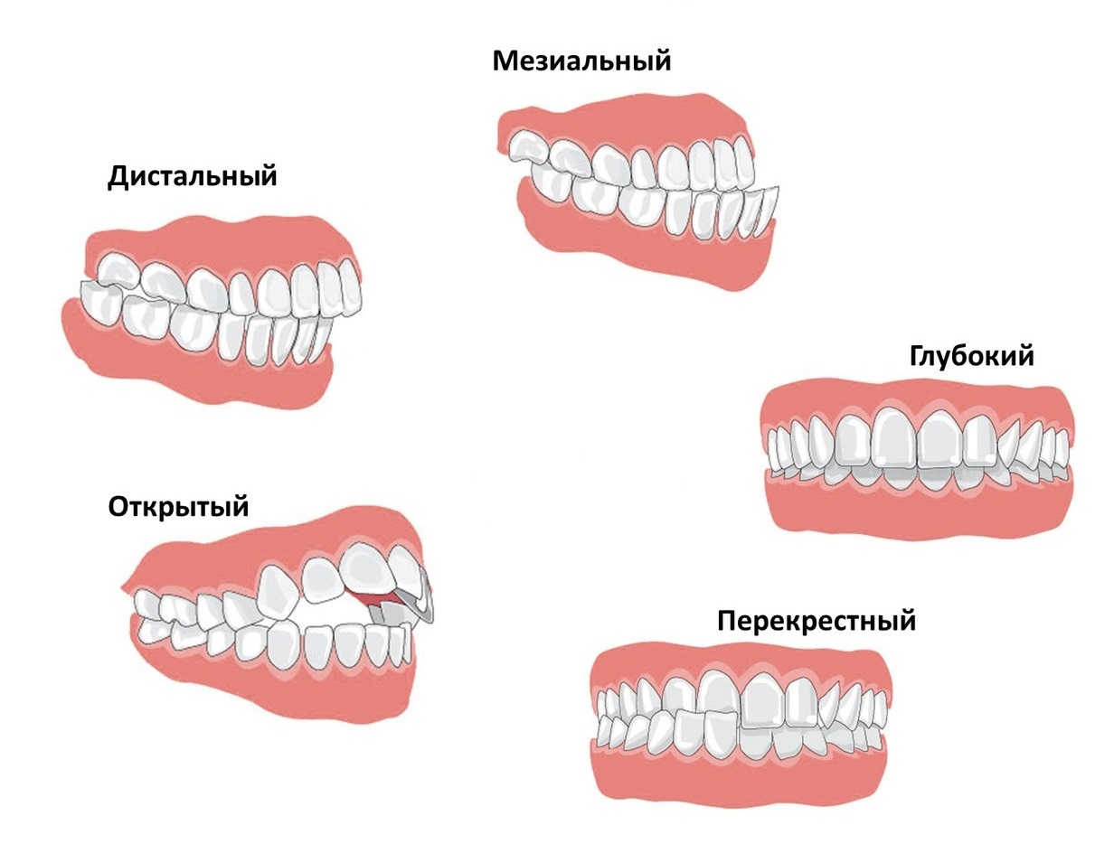 Как правильно снять верхнюю челюсть
