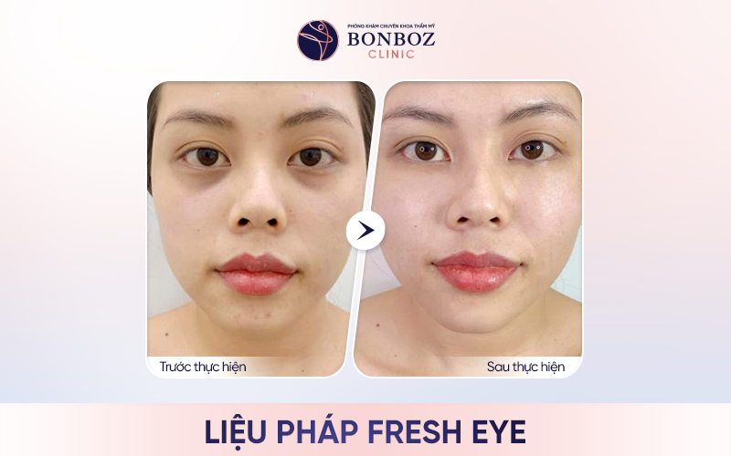 Liệu pháp Fresh Eye - Phương pháp chuyên biệt nhằm giảm thâm hiệu quả tại BonBoz