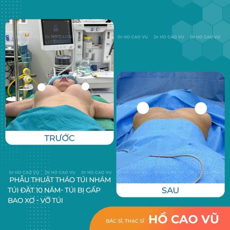 Tháo túi ngực cho khách đã đặt 10 năm: Túi bị gấp, vỡ túi, bao xơ 