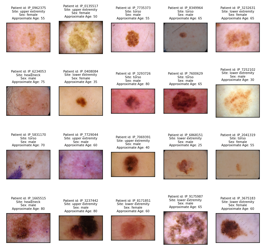 Multimodal ML for this melanoma detection model uses a patient’s structured data as well images of their lesions.