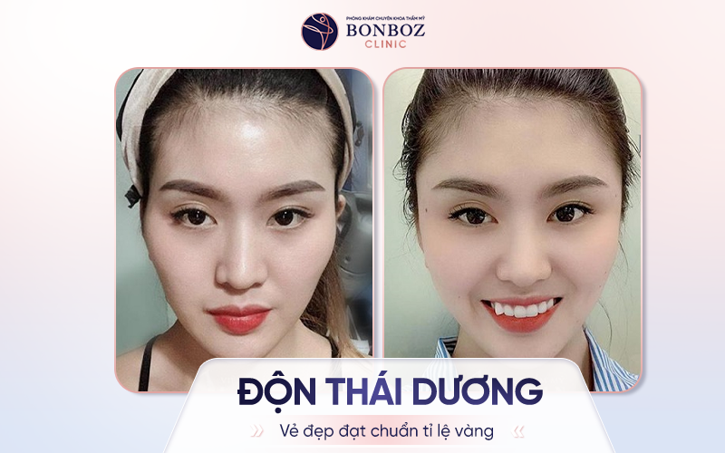 Độn thái dương giúp gương mặt thanh tú hơn